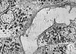 M,18y. | dilated primary bile ducts - blocked bile transport